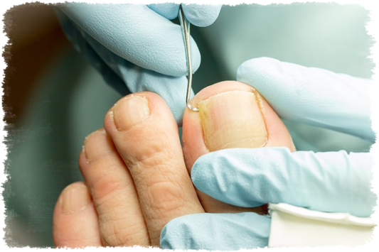 Medizinische Fachfusspflege bei Nagelpilz von La Bellaposa Nagelpilz und Hornhautbehandlung von La Bellaposa Schmitten