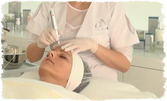 Micro Needling Behandlung von La Bellaposa Professionelle Kosmetik Microneedling La Bellaposa Schmitten